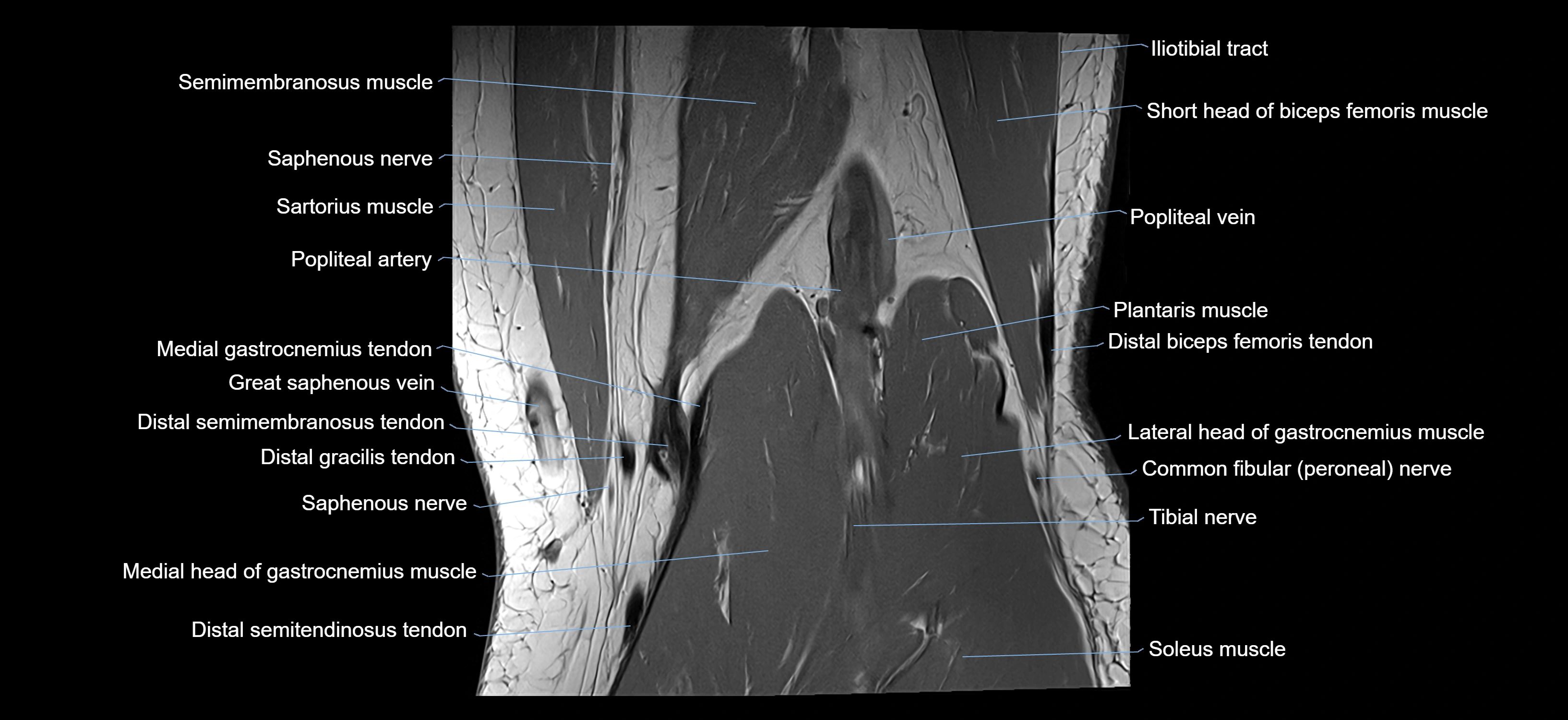 MRI knee coronal cross sectional anatomy labelled 3T radiology  image-04001-00033.webp